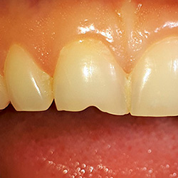 Восстановление сколов режущего края зуба