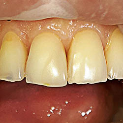 Реставрация зубов винирами прямым методом