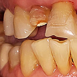 Восстановление зубов безметалловой конструкцией
