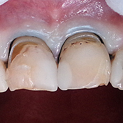 Реконструкция формы зубов